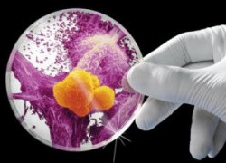 Что стоит за смертью американских врачей, эффективно лечивших рак и аутизм альтернативными методами с использованием GcMAF