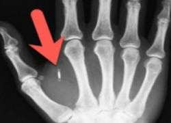 Шведы добровольно позволяют загонять себе под кожу микрочипы