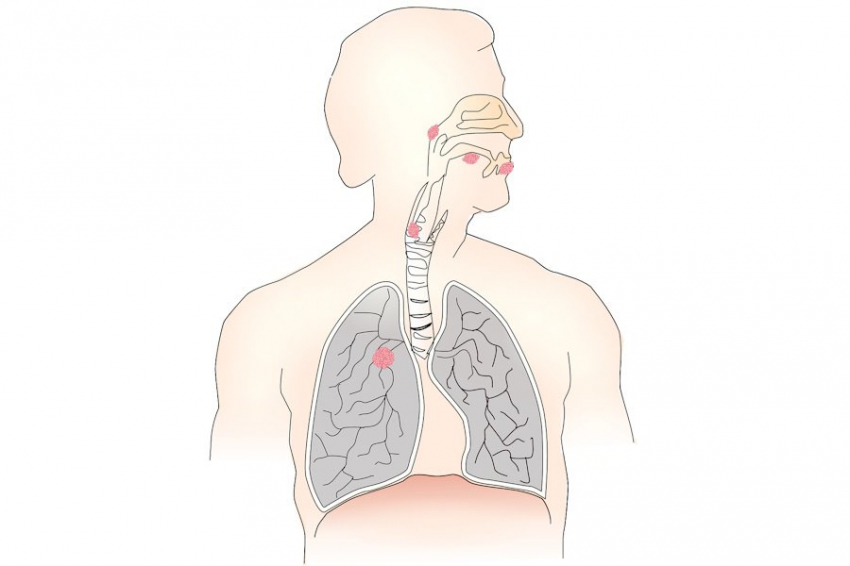 Исследования выявили связь между частицами PM2.5 и раком легких