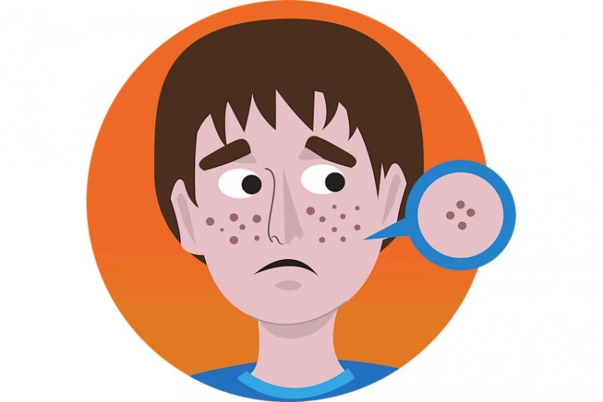 Диета против прыщей: рыба и омега-3 могут очистить вашу кожу