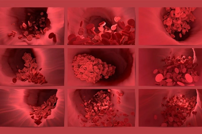 Генетический код тромбоза: у дагестанцев самый высокий риск