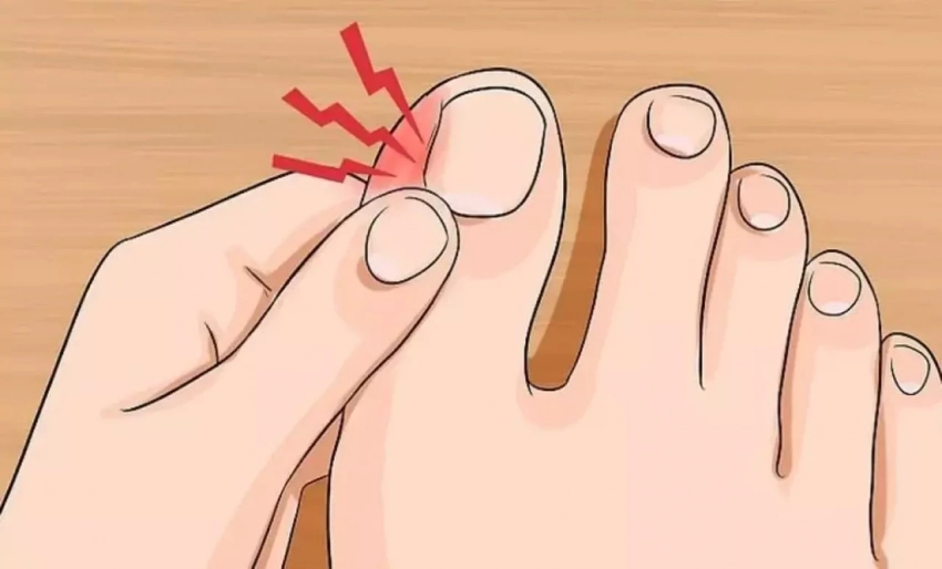 Как победить вросший ноготь и грибок на ногах